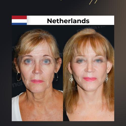 صور قبل وبعد لمرضانا 4